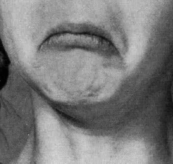 Note Mouth Corners and Dimpled Chin